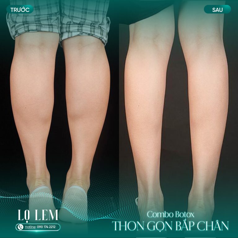 Combo filler Tiêm hốc mắt copy 2