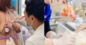 Hình ảnh khách hàng thực hiện treo sa trễ tại Bệnh viện Thẩm mỹ Siam ThaiLand