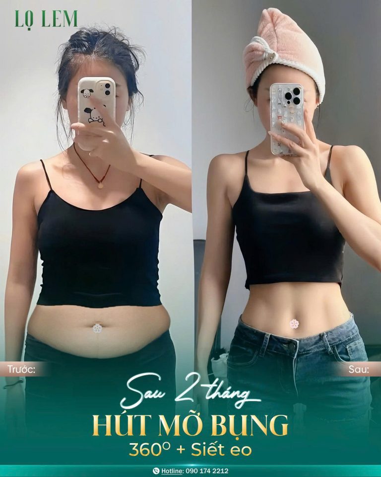 508476821_750572084209470_849762767703916097_n khách hàng hút mỡ tại Lọ Lem sau 2 tháng