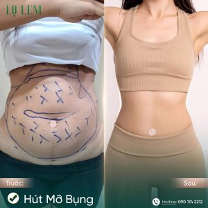 hút mỡ bụng tại Lọ Lem an toàn