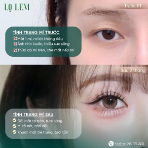 cắt mí đẹp và an toàn tại Lọ Lem