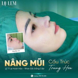 nâng mũi đẹp và an toàn tại Lọ Lem với cấu trúc Trung Hoa