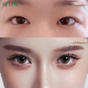 Các phương pháp cắt mí phổ biến hiện nay