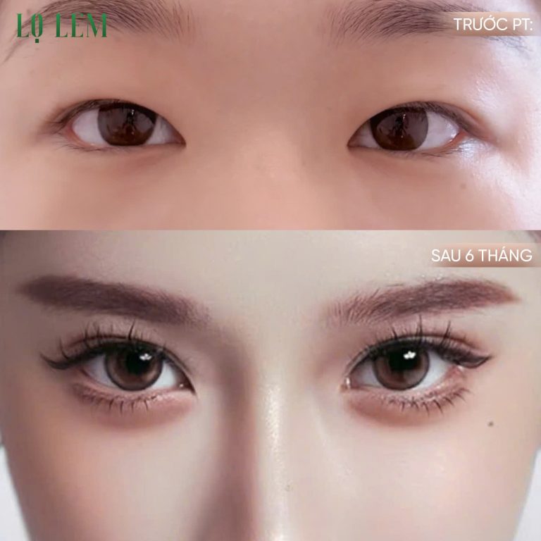 577066282_863178876282123_4012021142152546274_n Các phương pháp cắt mí phổ biến hiện nay