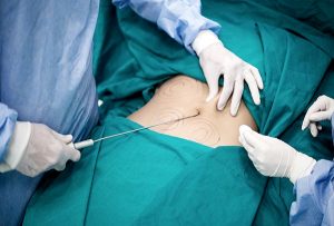 cấy mỡ tự thân an toàn