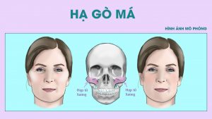 Hạ Gò Má Bao Nhiêu Tiền? Giá tại 7 Bệnh Viện Thẩm Mỹ An Toàn