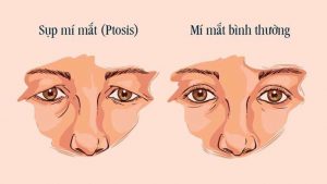 phẩu thuật sụp mí mắt