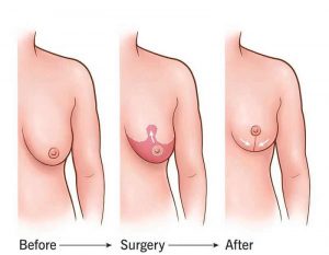 treo ngực sa trễ