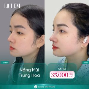 Nâng Mũi Cấu Trúc Trung Hoa Là Gì? Xu Hướng Mũi Hot Trend 2026