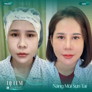 Nâng Mũi Cấu Trúc Trung Hoa Là Gì? Xu Hướng Mũi Hot Trend 2026