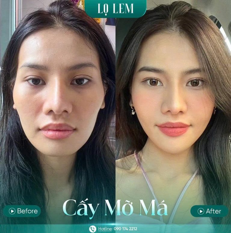 Kết quả của khách hàng sau khi cấy mỡ mặt Baby tại Lọ Lem