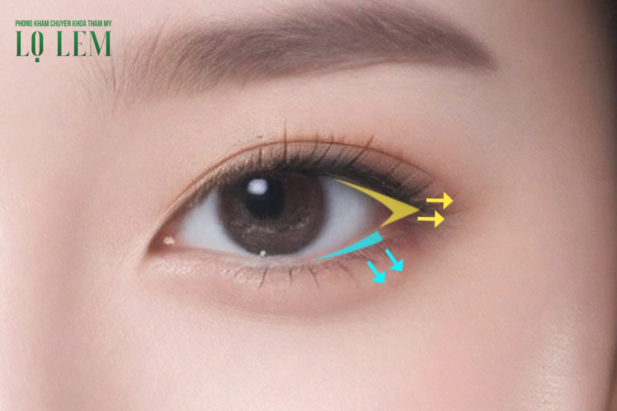 HÌNH ẢNH MINH HỌA HIỆU QUẢ TRƯỚC VÀ SAU KHI THỰC HIỆN MỞ RỘNG GÓC MẮT NGOÀI