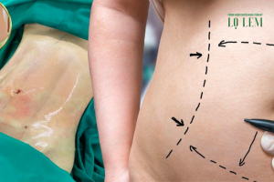 Tạo Hình Thành Bụng Bao Nhiêu Tiền? Chi Phí Mới Nhất Tại Top 7 Địa Chỉ Uy Tín