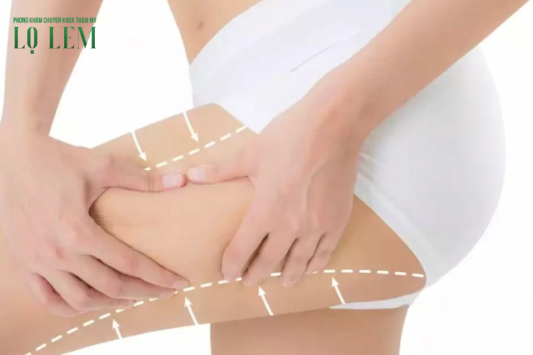 Hút Mỡ Đùi Bao Nhiêu Tiền? Chi Phí Tại 6 Cơ Sở Uy Tín