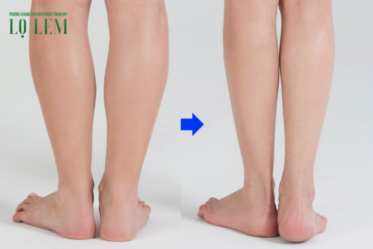 Hút Mỡ Bắp Chân Hết Bao Nhiêu Tiền? Giá Chi Tiết Tại Tp.hcm