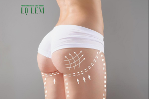 Địa chỉ nâng mông uy tín tại TP.HCM