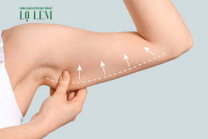 Chi phí hút mỡ bắp tay