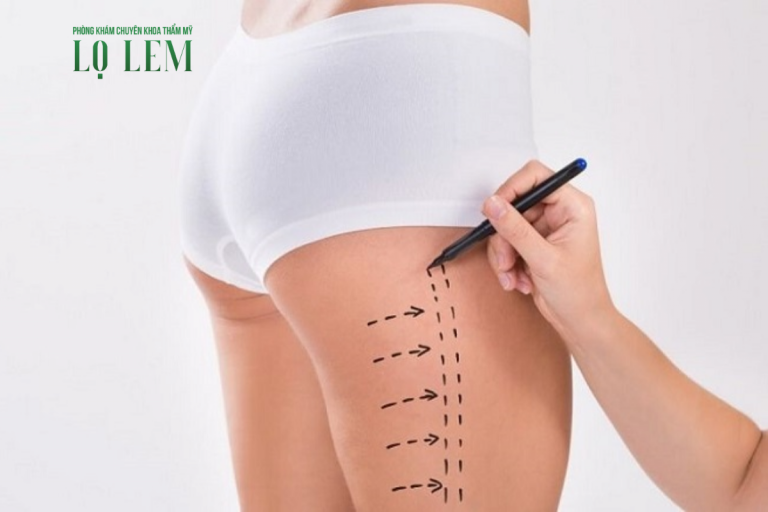 Hút mỡ đùi có an toàn không? Địa chỉ hút mỡ uy tín tại Tân Bình