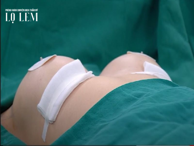 Nâng Ngực ở đâu Tốt? Top 7 địa Chỉ Nâng Ngực Uy Tín