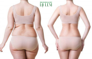 Hút mỡ lưng có đắc không? Bảng giá hút mỡ lưng tại Tân Bình