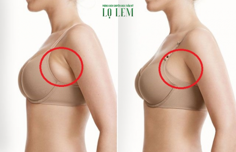 Top địa chỉ hút mỡ nách an toàn tại Tân Bình