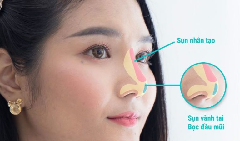 Nâng Mũi Bọc Sụn Tai Có Bền Không? Địa Chỉ Uy Tín Tại Tân Bình