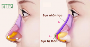Nâng Mũi Bằng Chỉ, Filler, Bọc Sụn Hay Cấu Trúc?