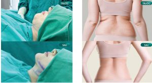 Review Top 7 địa Chỉ Hút Mỡ Giá Tốt Tại Quận Tân Bình