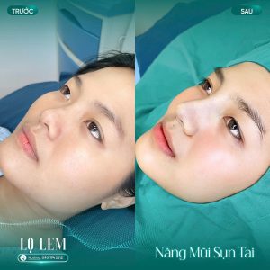 Hình ảnh trước và sau khi nâng mũi sụn tai của Khách hàng tại Lọ Lem