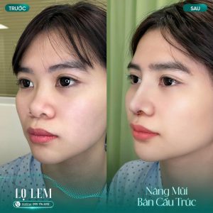 Nâng Mũi Hàn Quốc Giá Bao Nhiêu? Gợi ý địa Chỉ Uy Tín Tại Tân Bình