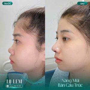 Nâng Mũi Hàn Quốc Giá Bao Nhiêu? Gợi ý địa Chỉ Uy Tín Tại Tân Bình