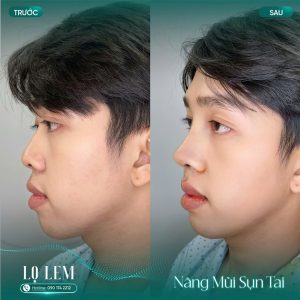 Nâng Mũi Bọc Sụn Tai Có Bền Không? Địa Chỉ Uy Tín Tại Tân Bình