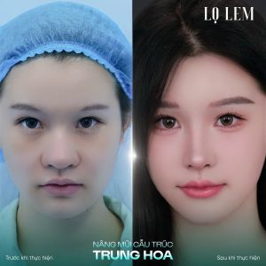 Nâng Mũi Cấu Trúc Trung Hoa Là Gì? Xu Hướng Mũi Hot Trend 2026