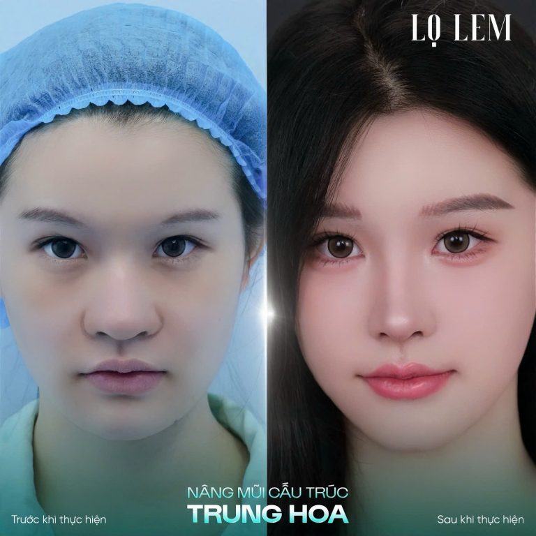 Nâng Mũi Cấu Trúc Trung Hoa Là Gì? Xu Hướng Mũi Hot Trend 2026