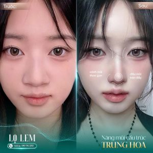 Nâng Mũi Cấu Trúc Trung Hoa Là Gì? Xu Hướng Mũi Hot Trend 2026