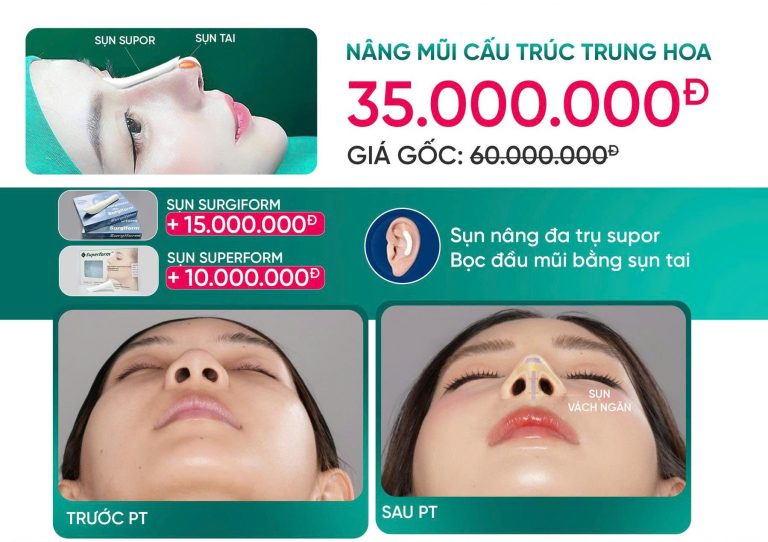 Nâng Mũi Cấu Trúc Trung Hoa Là Gì? Xu Hướng Mũi Hot Trend 2026