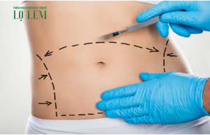 Có nên hút mỡ bụng không? Địa chỉ hút mỡ uy tín tại Tân Bình