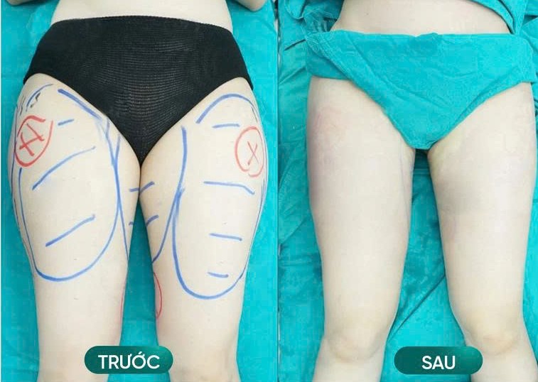 Hình ảnh trước và sau khi hút mỡ đùi của khách hàng tại Lọ Lem