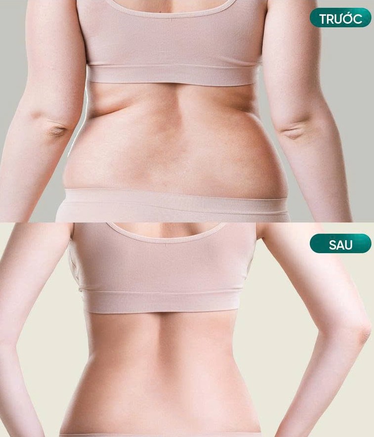 Review Top 7 địa Chỉ Hút Mỡ Giá Tốt Tại Quận Tân Bình