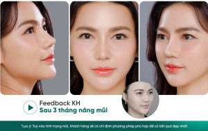 Hình ảnh khách hàng trước và sau khi nâng mũi tại Lọ Lem