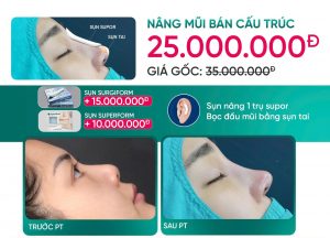 Bảng giá dịch vụ nâng mũi tại Lọ Lem
