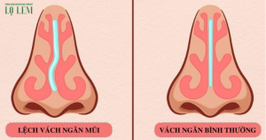 Cách Nhận Biết Mũi Bị Lệch? Địa Chỉ Sửa Mũi Tại Tân Bình