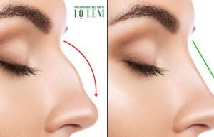 Cách Nhận Biết Mũi Bị Lệch? Địa Chỉ Sửa Mũi Tại Tân Bình